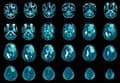 Un estudio aclara por qué la terapia CAR-T no funciona igual en todos los pacientes con glioblastoma