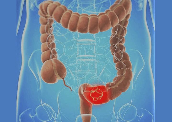El boom del “fibermaxxing”: la fibra puede convertirse en aliada contra el cáncer de colon